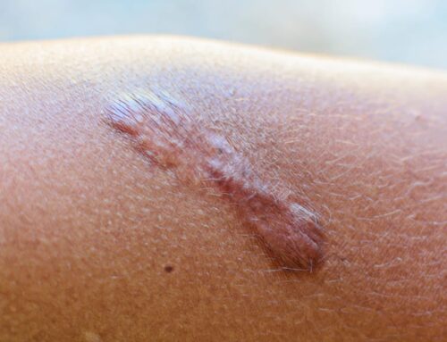 How to get rid of scars?