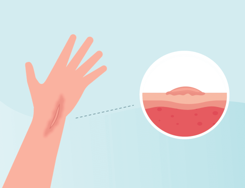 Scar tissue: causes, symptoms and proven treatment