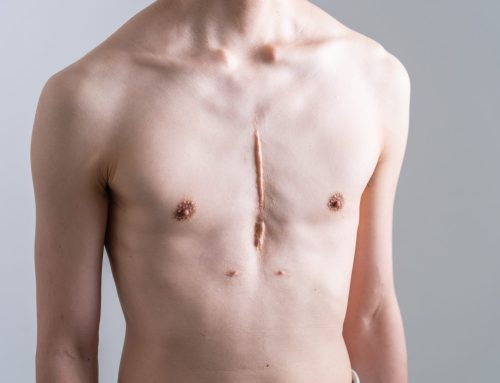 Thoracotomy and sternotomy scars: healing, risks and scar treatment